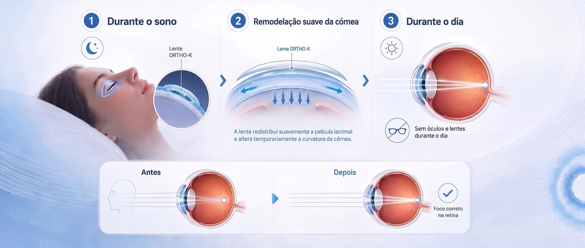 Como funciona a Ortho-K: durante o sono a lente remodela suavemente a córnea; durante o dia, visão nítida sem óculos